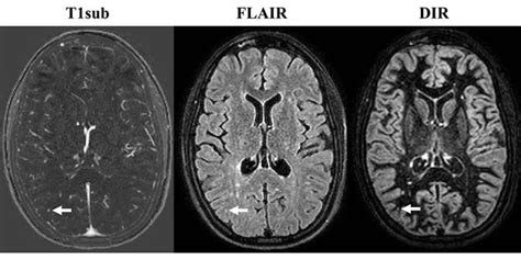 the villages brain mri with contrast|MRI and MS diagnosis .